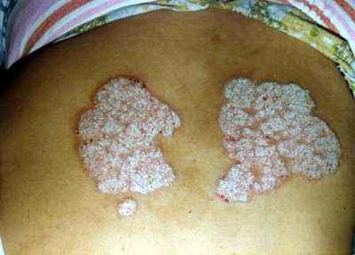 牛皮癣的类型分类有哪些