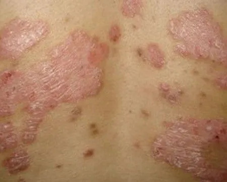 牛皮癣患者出门旅游注意什么