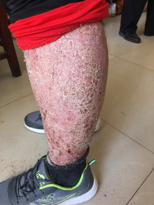 腿上长银屑病受哪些因素影响