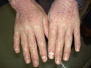 牛皮癣的饮食中可以有螃蟹出现吗？