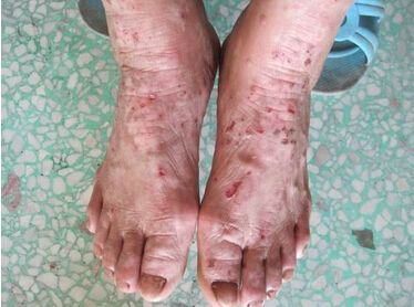 患有牛皮癣是有什么样的危害呢