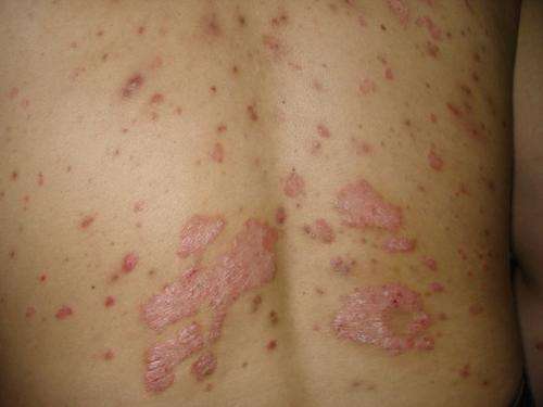 牛皮癣会不会传染