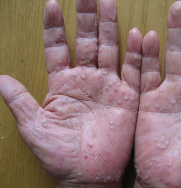 银屑病能使用什么药物进行治疗