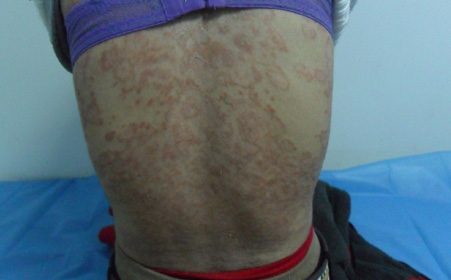 银屑病侵蚀肌肤一般会从身体那些部位开始