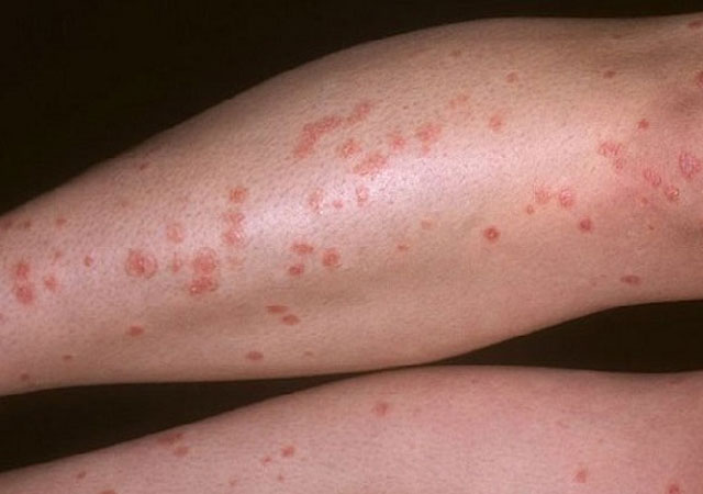 什么食物是牛皮癣患者不能吃呢