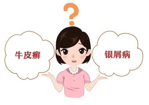 银屑病初期广东专家教你如何辨别病症