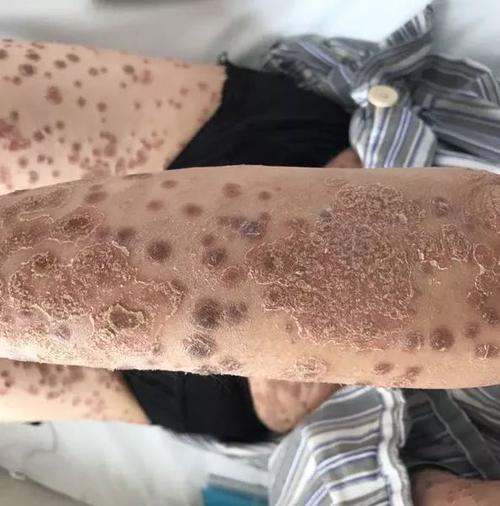 银屑病大多数人都会实现自愈吗