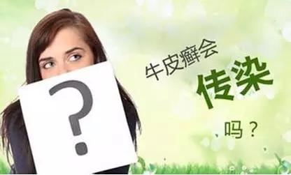 身体上的银屑病回家会不会传染给家人