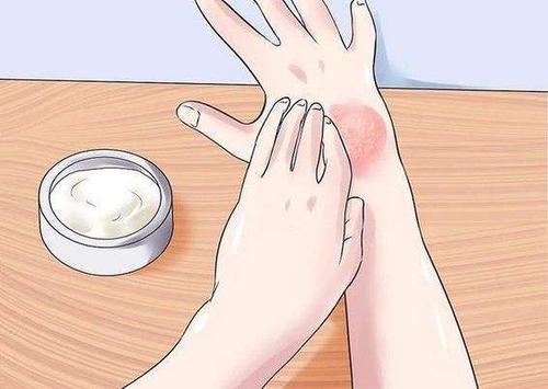 用药不当小心牛皮癣回头记仇