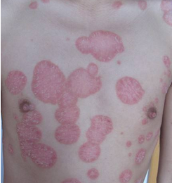 牛皮癣可以吃哪些鱼