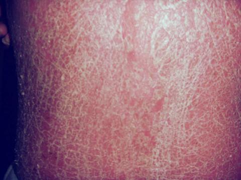 患上了红皮病型牛皮癣应该肿么办求救广州专家