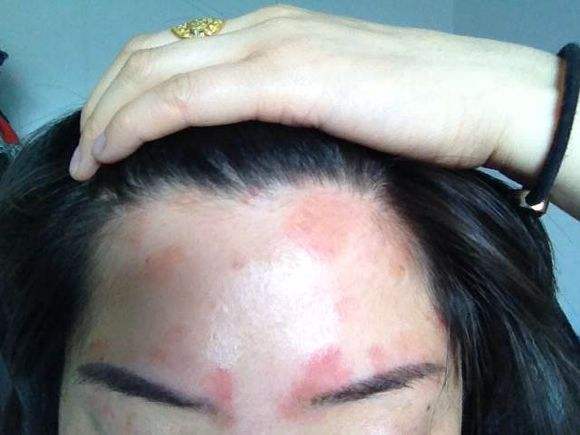 牛皮癣它会不会有传染性呢