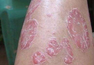 牛皮癣为什么难治