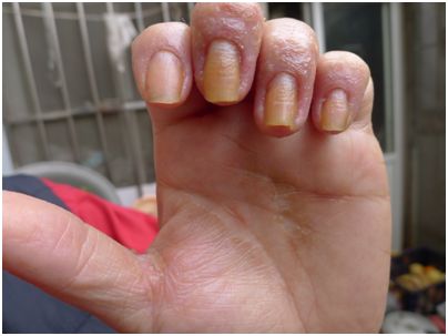 牛皮癣患者可以运动吗