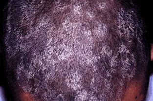 如果患上牛皮癣可以食用的食物有什么