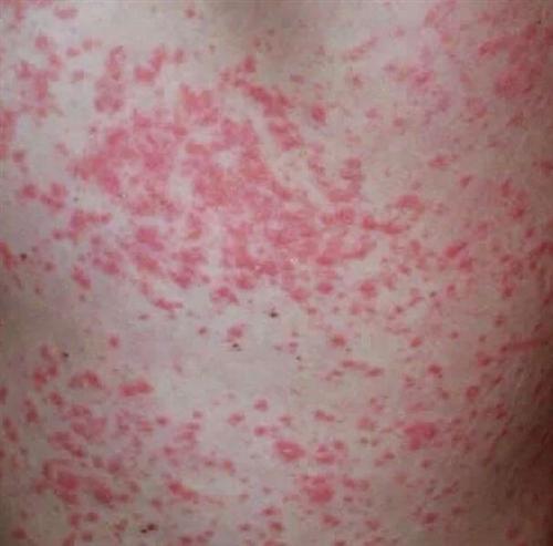 牛皮廯所表现的危害有哪些