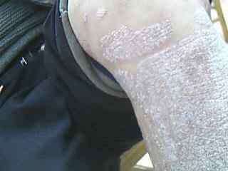 冬季牛皮癣患者如何调养身体