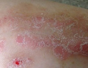 牛皮癣疾病为什么如此难以治疗康复呢