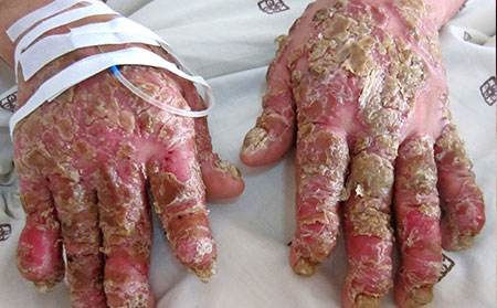 银屑病误诊将会给患者造成什么样的伤害