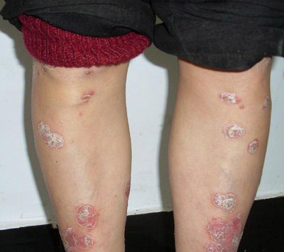 牛皮癣疾病会遗传吗