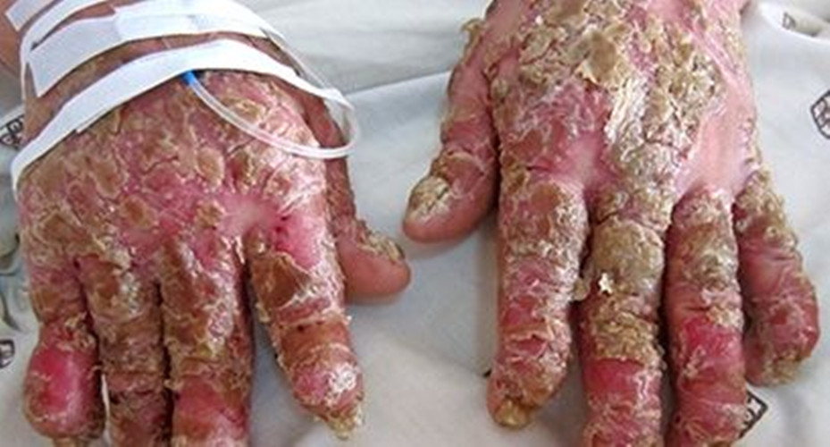 牛皮癣患者怎样饮食才健康