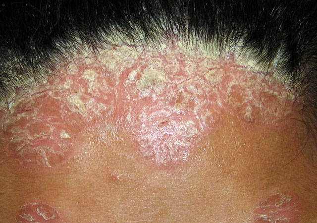 头部牛皮癣会引起脱发问题吗