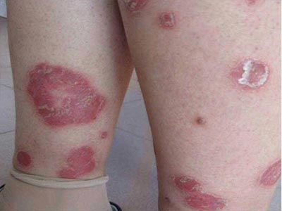 牛皮癣患者能否使用纹身贴