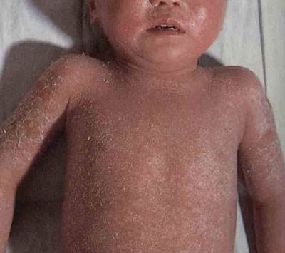 儿童患有牛皮癣要怎么注意这个饮食呢