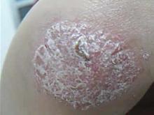 广州医生建议用端正的态度接受自己是银人