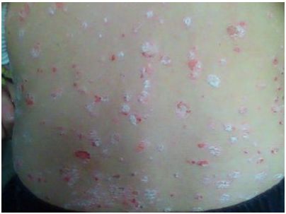 患上牛皮癣这个疾病能不能染发呢