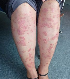 患了牛皮癣患者们不能吃的食物是有什么呢