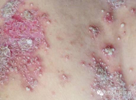 得了泛发型牛皮鲜需要如何治疗