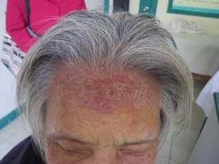 患牛皮癣患者们应该要注意什么诊断呢