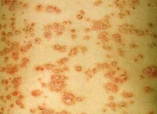 中老年银屑病患者能引发其他疾病吗