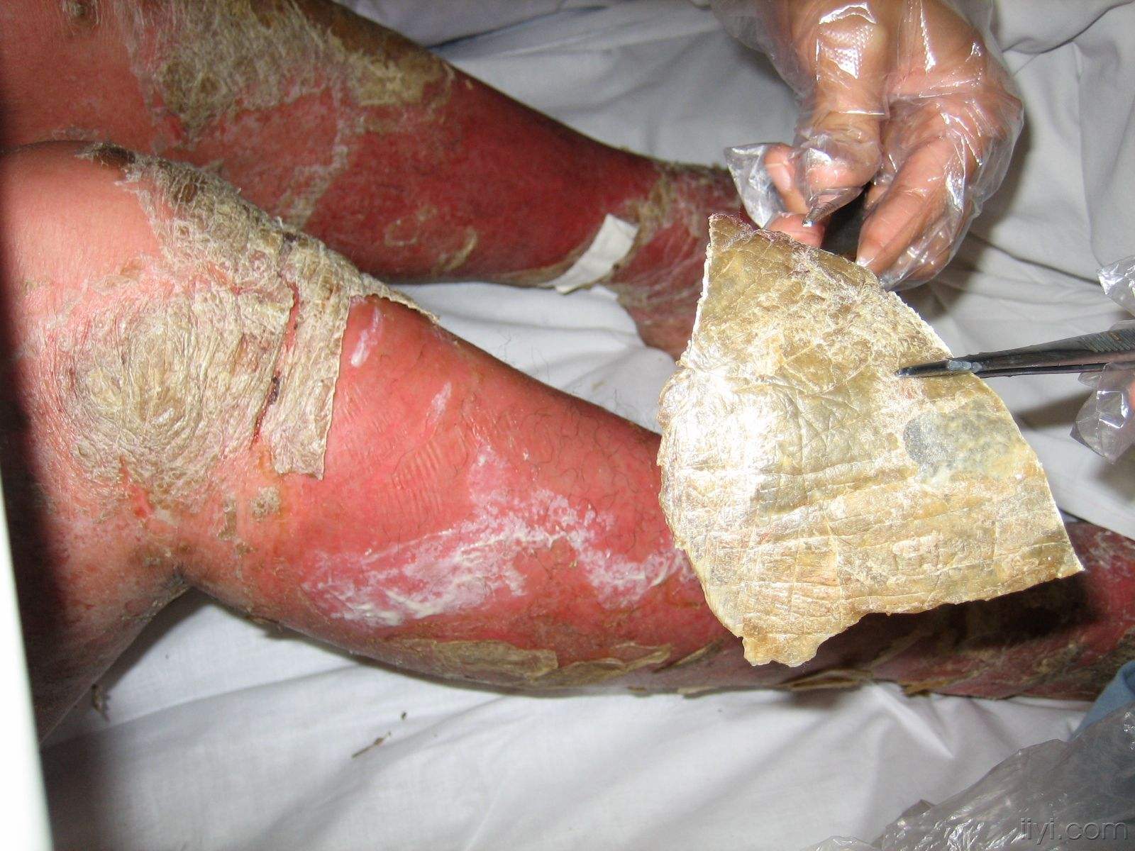 牛皮癣容易对患者们的关节造成损害如何护理