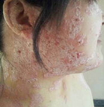 儿童牛皮癣为什么越早治疗效果越好