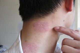 关于牛皮癣患者们日常中要怎么进行预防呢