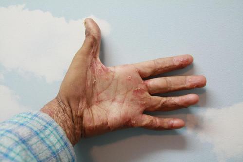 广州治疗银屑病医院如何挑选好