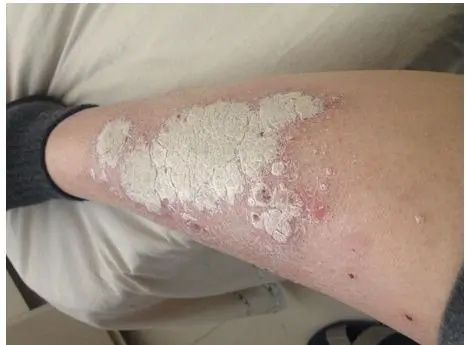 牛皮癣患者如何减轻压力