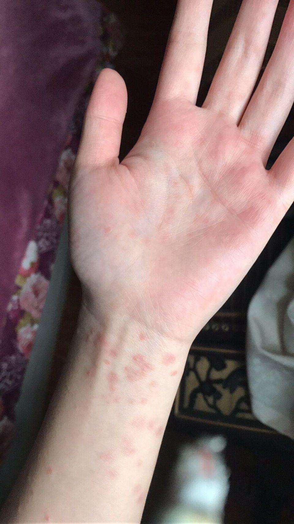 牛皮癣患者们日常中应该要怎么做