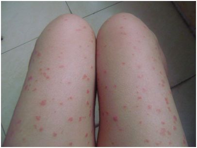 患者的抗病能力弱会引发牛皮癣疾病吗