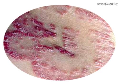 不配合治疗的牛皮癣患者后来怎么样了