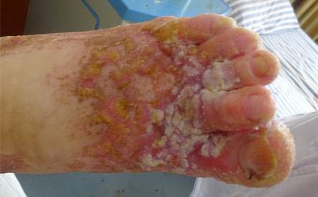 听说牛皮鲜的皮损消退来去无踪