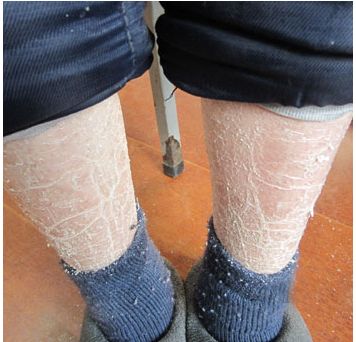 银屑病的治疗偏方可以相信吗