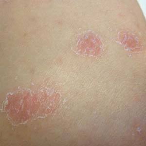 牛皮癣时常复发如何护理