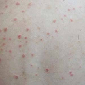 关节病型牛皮癣会有什么样的治疗建议呢