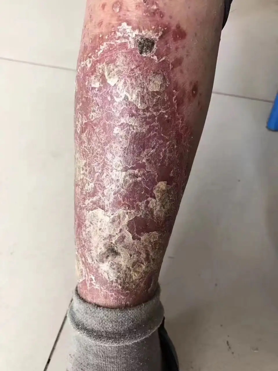 腿部牛皮癣患处皮肤怎么护理