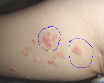 癣魔降临不能连累后代:得了牛皮癣还能生育吗