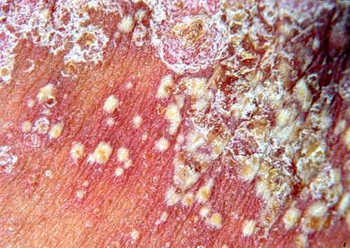 康复案例：丈夫嫌弃我“脏”都是因为患上了银屑病