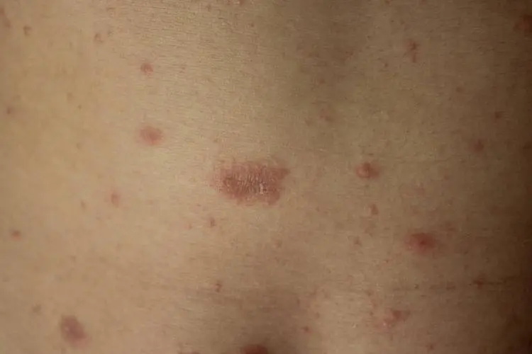 牛皮癣患者可以减肥吗